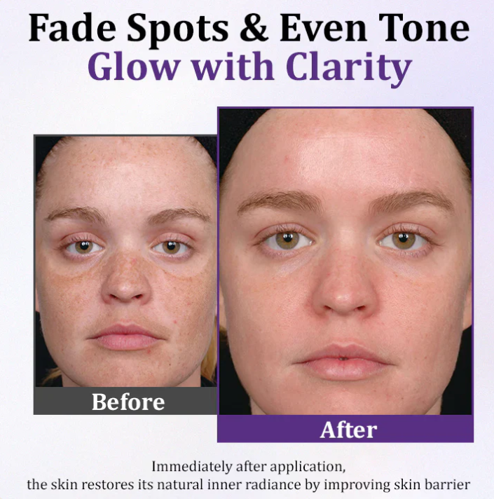 Lovilds Epiglow Melanev Advanced Anti Pigmentation Cream