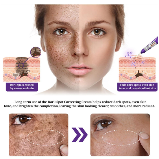 Lovilds Epiglow Melanev Advanced Anti Pigmentation Cream