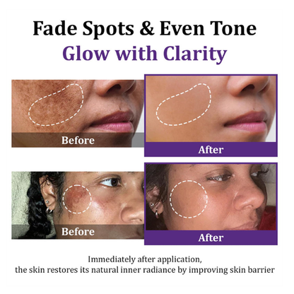 Lovilds Epiglow Melanev Advanced Anti Pigmentation Cream